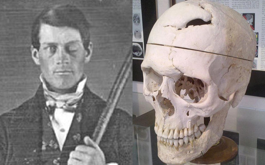 Phineas Gage: Neuroscience’s Most Famous Patient.